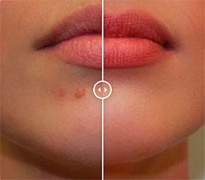 extraccion de lunares