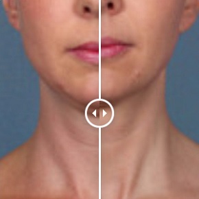 kybella